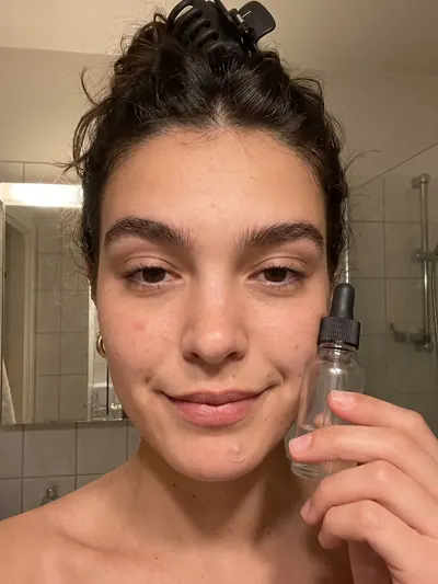 Bathroom selfie: holding a dropper bottle to her cheek, a small red bump on her jaw.