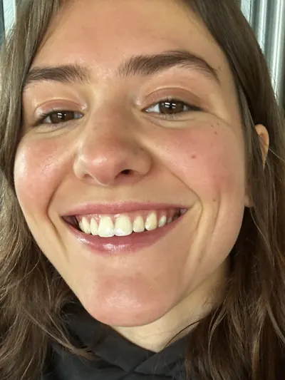Low-angle selfie, laughing, long brown hair, a few red marks on one cheek.